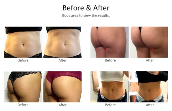 EMS Sculpt before and after results for buttock lifting and shaping.