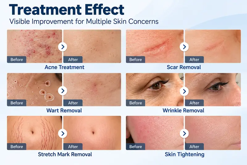 Fractional CO2 laser before and after results